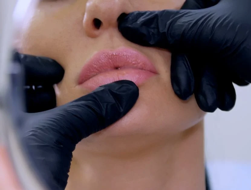 Provider assessing lips before cosmetic treatment for vertical lip lines