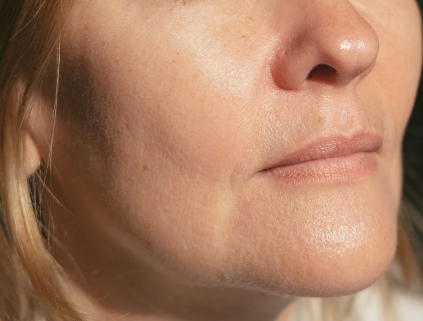 Smooth skin texture after professional dermaplaning treatment